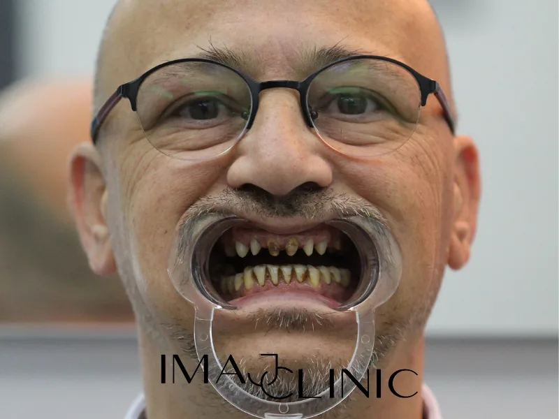 Tedavi öncesi vaka 7