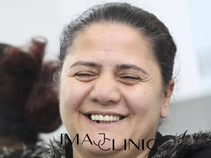 Tedavi öncesi vaka 20